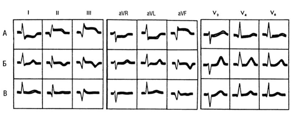 Электрокардиографическая динамика Q-инфаркта миокарда нижней стенки левого желудочка
