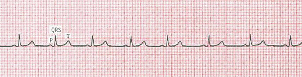Основной повторяемый сердечный цикл P-QRS-T