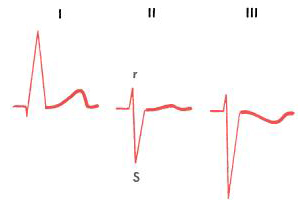 Отклонение электрической оси сердца влево