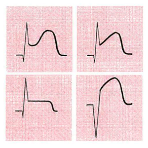 Различные типы подъёма сегмента ST при остром инфаркте миокарда