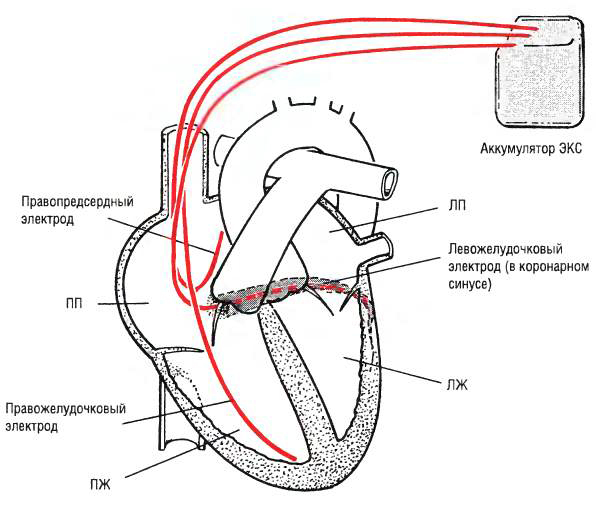 Бивентрикулярный кардиостимулятор