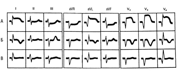 Электрокардиографическая динамика Q-инфаркта миокарда передней стенки левого желудочка