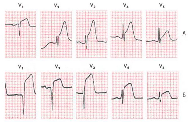 Электрокардиограмма грудных отведений при остром переднем инфаркте миокарда
