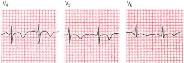 He-Q-инфаркт миокарда у больного с острой болью в грудной клетке и повышением уровня кардиоспецифических ферментов
