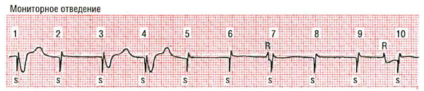 Нарушение работы кардиостимулятора: отсутствие распознавания и стимуляции